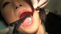 待望！！【虫歯銀歯治療】虫歯箇所計4カ所　削りまくりの130分 心配性森ほたるの虫歯治療