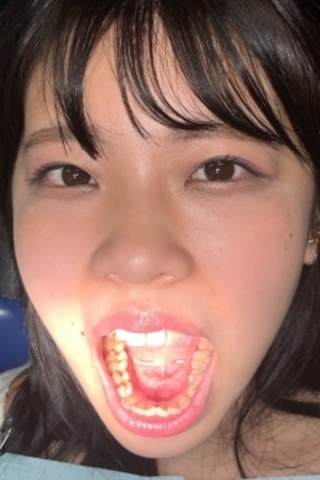 【治療3日目 銀歯装填＋親知らず虫歯治療】誕生日を歯医者で迎える永野楓果(25)幸せから一転！？痛すぎて泣いちゃう…