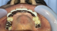 フェチ：熟女の歯観察。郁美さんのいじくりまくった歯治療の成れの果て！