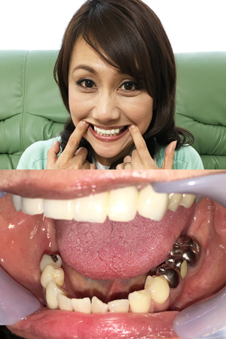 熟女の歯観察。郁美さんのいじくりまくった歯治療の成れの果て！