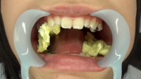 【歯観察】柚希ちゃん(25)銀歯４本と虫歯もあり。変形八重歯も披露！