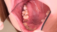 【歯観察】桜ねね(23)虫歯の巣窟！久々の複数崩壊歯に縁下歯石のコラボレーション！！