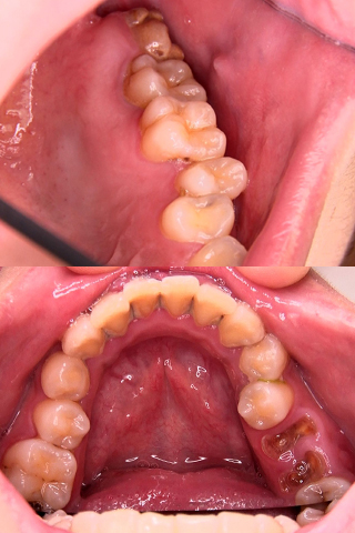 【歯観察】桜ねね(23)虫歯の巣窟！久々の複数崩壊歯に縁下歯石のコラボレーション！！