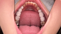 【歯観察】まさみさん(30)銀歯＆セラミックだらけの口内は必見！
