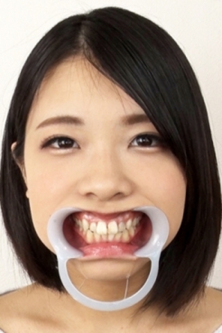 【歯観察】楓果ちゃん(23)ステインびっちりと思いきや崩壊歯へまっしぐら！