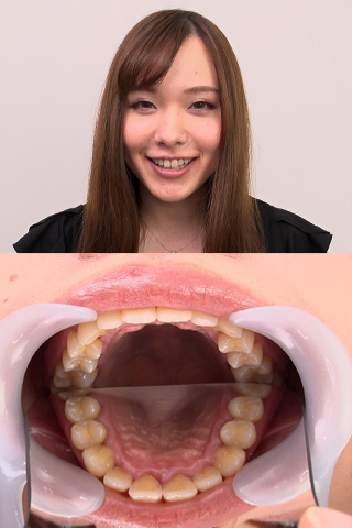 【歯観察】琴菜ちゃん(23)の歯をじっくり観察