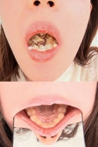【歯観察】前歯4本全部セラミック治療　かれんのお口の中～咀嚼観察