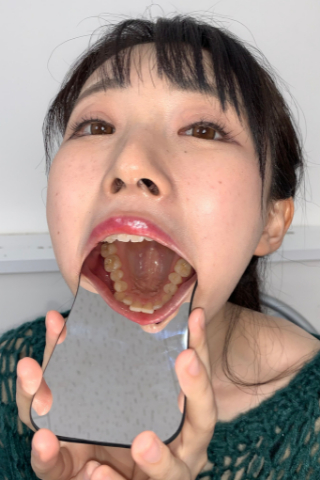 【歯観察】奥歯全部痛くて困ってます...八重歯の可愛い美少女ひかるの歯診断!!