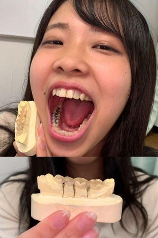 【歯フェチLABO連動企画】永野楓果 銀歯4連歯型～1週間装着した詰め物を添えて～