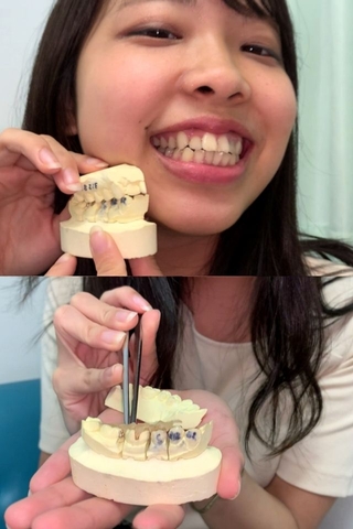 【歯フェチLABO連動企画】永野楓果 銀歯4連歯型～1週間装着した詰め物を添えて～