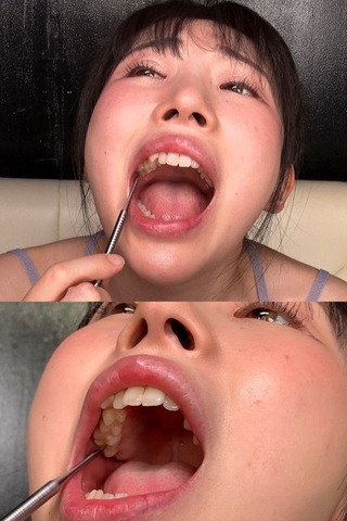 【虫歯治療のその後】『奥歯が痛いんですぅ』と嘆く皆月ひかるの歯をあの手この手で攻めてみた。