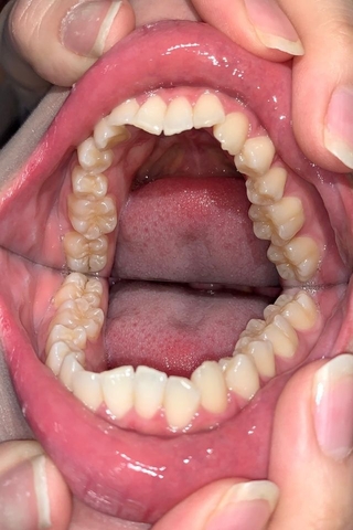 21年間虫歯ゼロ！！「元の歯黄色いと虫歯になりにくいです。」と豪語する涼花くるみ(21)の口内