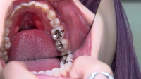 フェチ：【虫歯3箇所銀歯治療】銀歯さんいらっしゃい！！左上6番左下6番7番に初の銀歯を装着するまやちゃん(24)