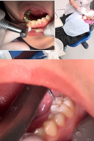 【虫歯3箇所銀歯治療】銀歯さんいらっしゃい！！左上6番左下6番7番に初の銀歯を装着するまやちゃん(24)