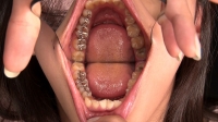 フェチ：最終日は神経喪失スレスレの大虫歯含む4箇所治療！永野楓果(25)合計22カ所の虫歯治療の結末