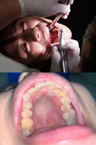 【歯医者治療映像のみ】麻酔と歯医者が大好きな超絶美女!!!永野つかさの前歯２箇所虫歯治療