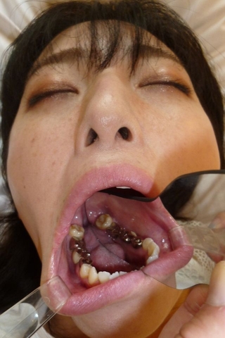 【口腔仙人監督作品】新しい銀歯が入るも細菌の塊かごっそりで血だらけの口腔内の麻衣さん(治療２～4日目収録)