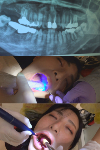 【口腔仙人監督作品】新しい銀歯が入るも細菌の塊かごっそりで血だらけの口腔内の麻衣さん(治療２～4日目収録)