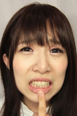 喜多方涼(25)【歯科治療映像】涼ちゃん(25歳)まさかの先天性欠損歯が発覚！
