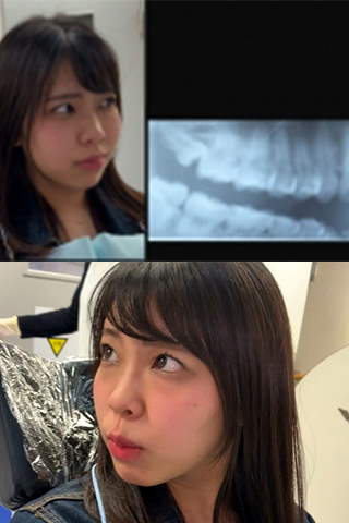 【歯科治療映像】虫歯総合計１６本 可愛い顔して口の中がヤバい女 永野楓果(24）
