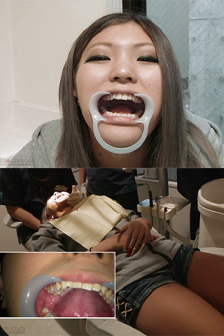 【リアル歯科治療】立花みか（19歳）銀歯埋め込み治療映像【銀歯・奇形歯】