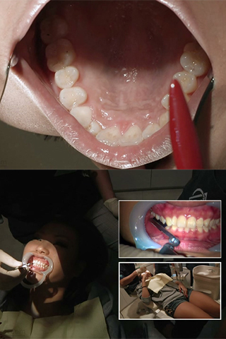 【リアル歯科治療】立花みか（19歳）銀歯埋め込み治療映像【銀歯・奇形歯】