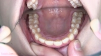 フェチ：【まや(24)虫歯治療１日目】痛みを感じながらも放置し続けた結果、５本の虫歯を治療する羽目に。