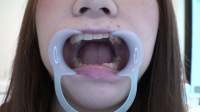 フェチ：芹沢かえで(20)【歯科医師治療映像】親不知抜歯麻酔が効きにくい体質