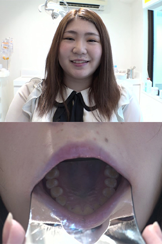 芹沢かえで(20)【歯科医師治療映像】親不知抜歯麻酔が効きにくい体質