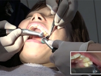 高田明日香(23)【歯科医師治療映像】左上4番5番銀歯治療＆最強縁下歯石除去