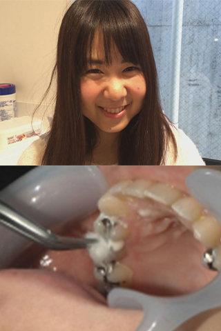 【過去最強虫歯治療】美少女若菜しずく（22歳）銀歯2箇所埋め込み治療