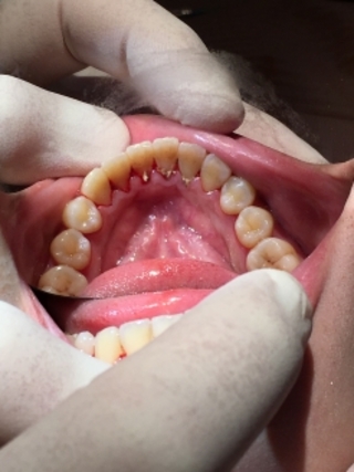 【歯科治療】『歯周病！？歯肉縁下歯石除去』