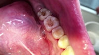 星野桃子(21)第２弾【歯科医師治療映像】左下6,7番銀歯治療リアルドキュメント