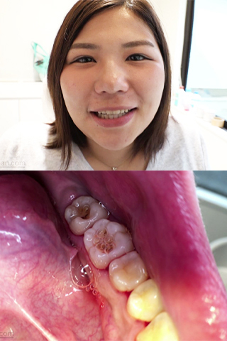 星野桃子(21)第２弾【歯科医師治療映像】左下6,7番銀歯治療リアルドキュメント