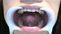 フェチ：香坂はるな(21)【歯科医師治療映像】左下4番5番虫歯治療映像