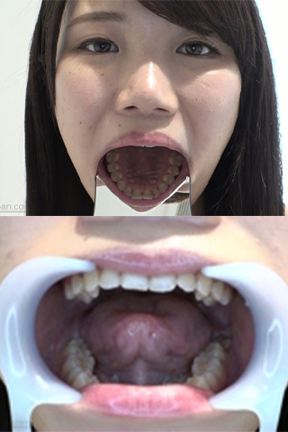 香坂はるな(21)【歯科医師治療映像】左下4番5番虫歯治療映像