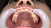 【歯科医師治療映像】右上３番Ｃ２虫歯治療映像