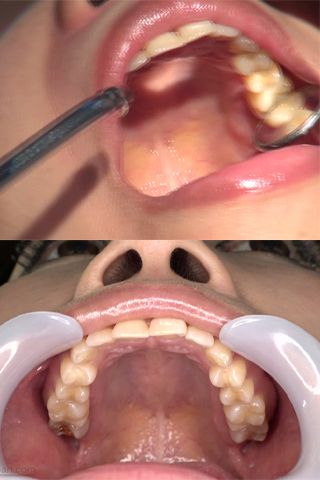 【歯科医師治療映像】右上３番Ｃ２虫歯治療映像