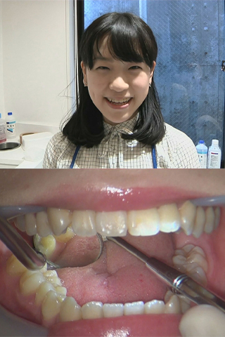 『歯医者で虫歯治療２箇所　桜ちゃん』