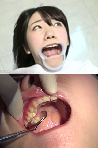 柏木茉奈(20)【歯科治療映像】集中治療でインレー3本＆先天性欠如歯