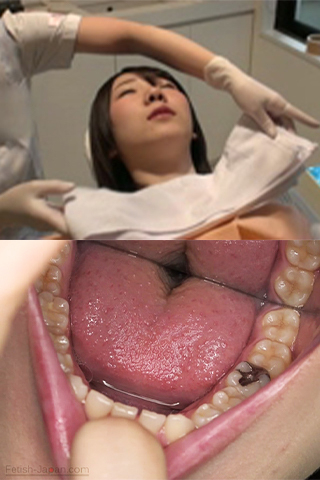 柏木茉奈(20)【歯科治療映像】集中治療でインレー3本＆先天性欠如歯