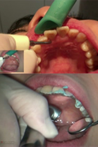 おっとりしたエミちゃんのヤバーい前歯診療•歯石除去クリーニング