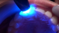 石川みなみ(26)【歯科治療映像】一挙に3本治療します。銀歯2本も輝いてるよ！
