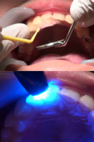 石川みなみ(26)【歯科治療映像】一挙に3本治療します。銀歯2本も輝いてるよ！
