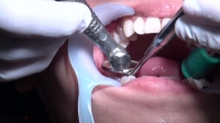 フェチ：まこと(23)【歯科治療映像】ついに抜髄の撮影に成功しました！