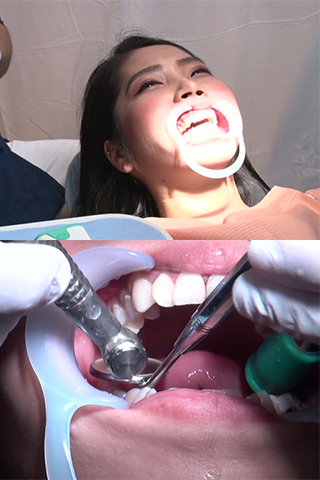 まこと(23)【歯科治療映像】ついに抜髄の撮影に成功しました！