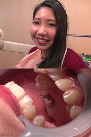 まこと(23)【歯科治療映像】ついに完成！フルメタルクラウン装着までの全貌！！