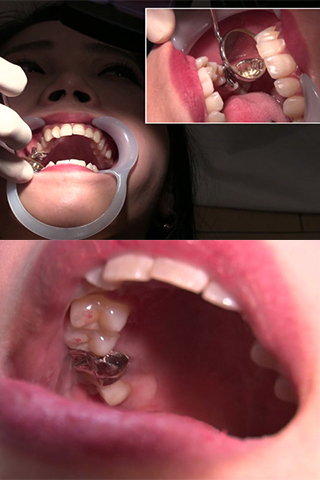 まこと(23)【歯科治療映像】ついに完成！フルメタルクラウン装着までの全貌！！