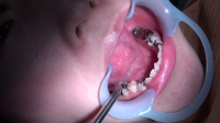 フェチ：あおい(24)【歯科治療映像】なんと銀歯12本のつわものの根幹治療！