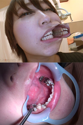 あおい(24)【歯科治療映像】なんと銀歯12本のつわものの根幹治療！